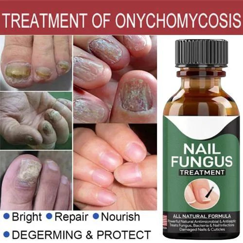 Fast Nail Fungal Treatments Nail Repair Essences Serum